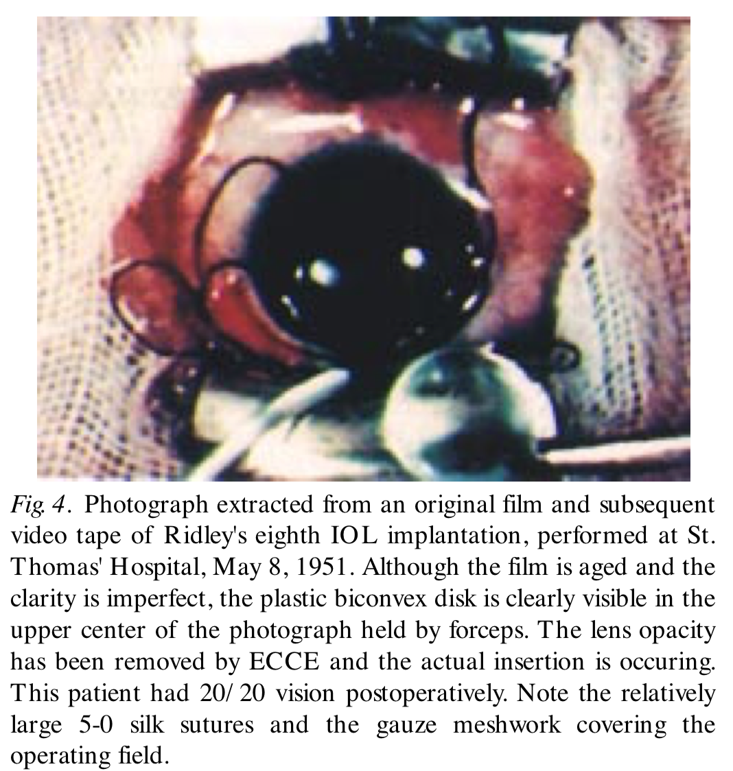Ridley's eighth IOL implantation, performed at St. Thomas' Hospital, May 8, 1951