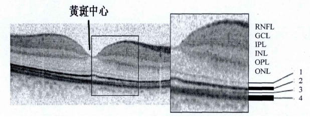 OCT技术对视网膜成像的示意图