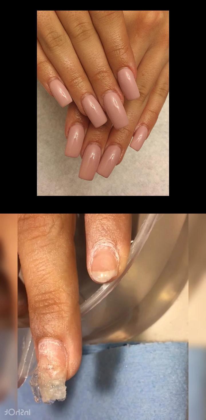 ingrown toenail treatment,nail polish remover,Gel Nude Pink Square Nails I had done a fill for this client on nails that werenoriginally my work. When we soaked them off, you can CLEARLY see the difference between the MMA acrylic (the smooth, sticky pinky nails) and the EMA acrylic (the chunky ring finger) and the middle finger that had half MMA half EMA. love this video. Your nails should look like the ring finger when you soak off your nails, ladies! . . Tags: , emaacrylic , mmaacrylic , soakoffnails , soakoff , nailsoakoff , nailcare , fakenails , acrylicnails , naturalnails , nailremoval , cry 