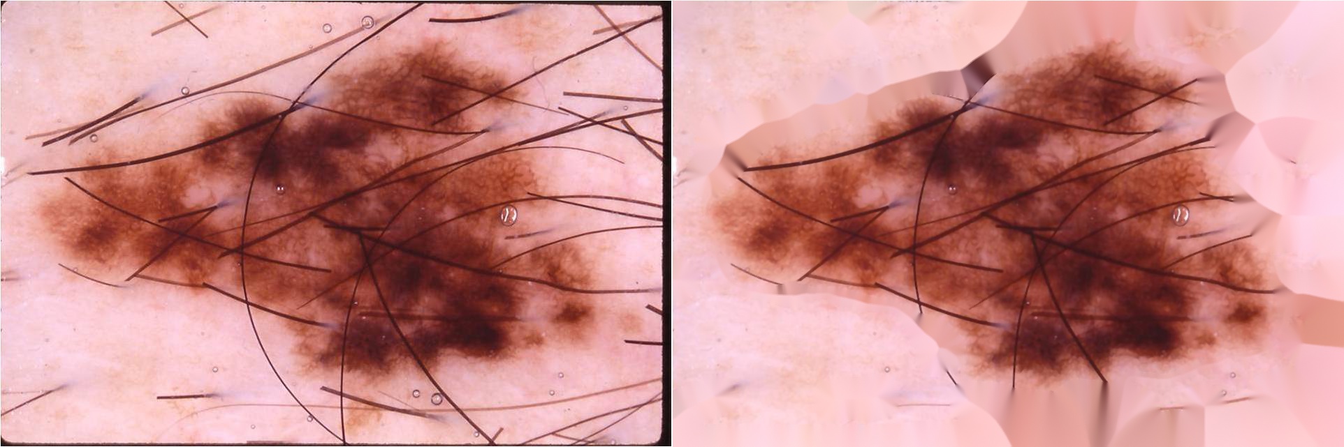 GitHub ATX735/DIPSkinHairRemoval 使用opencv进行图像处理去除毛发，以一篇论文作为参考来实现