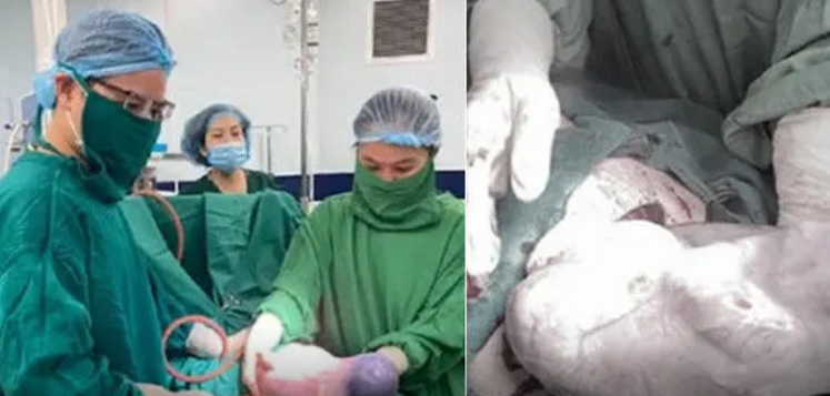 孕妇剖腹产生下双胞胎 医生抱出第二个孩子时惊呆了【图】